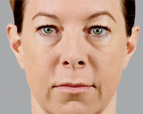 after treatment of juvederm
