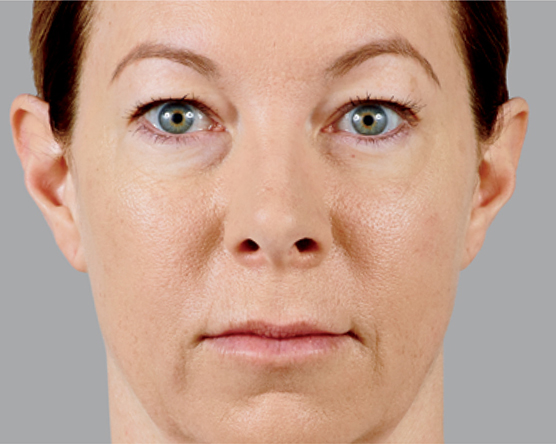 before treatment of juvederm treatment