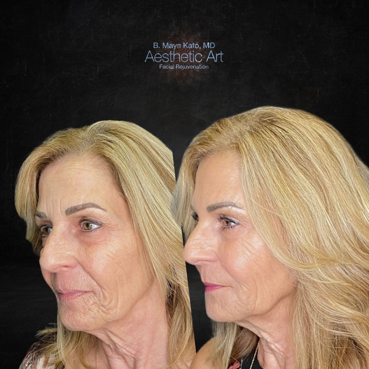 Juvéderm Transform Your Appearance with Dermal Fillers Aesthetic Art Dr Maya Kato