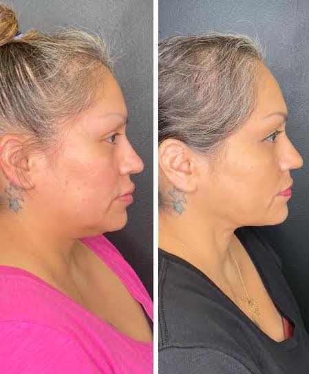 This patient is shown 3 months after undergoing FaceTite treatment to the neck. This minimally invasive procedure uses radiofrequency-assisted lipolysis (RFAL) to tighten skin and reduce fat, delivering surgical-like results without the need for incisions or visible scarring. With stable weight and no changes in lifestyle, her enhanced neck contour is solely the result of FaceTite. She experienced minimal downtime and is absolutely thrilled with her natural-looking, rejuvenated results!